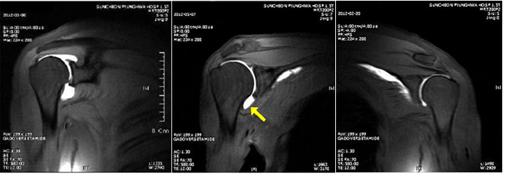 정상 견관절 MRI와 오십견의 MRI. 정상(화살표)에 비해 오십견의 견관절은 관절낭이 유착되어 작아져 있음.