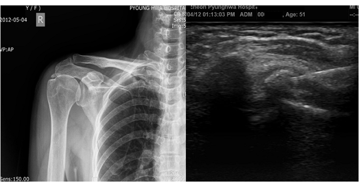 우측 어깨에서 관찰되는 석회화 건염. 초음파 유도 하에 석회를 제거하는 모습.